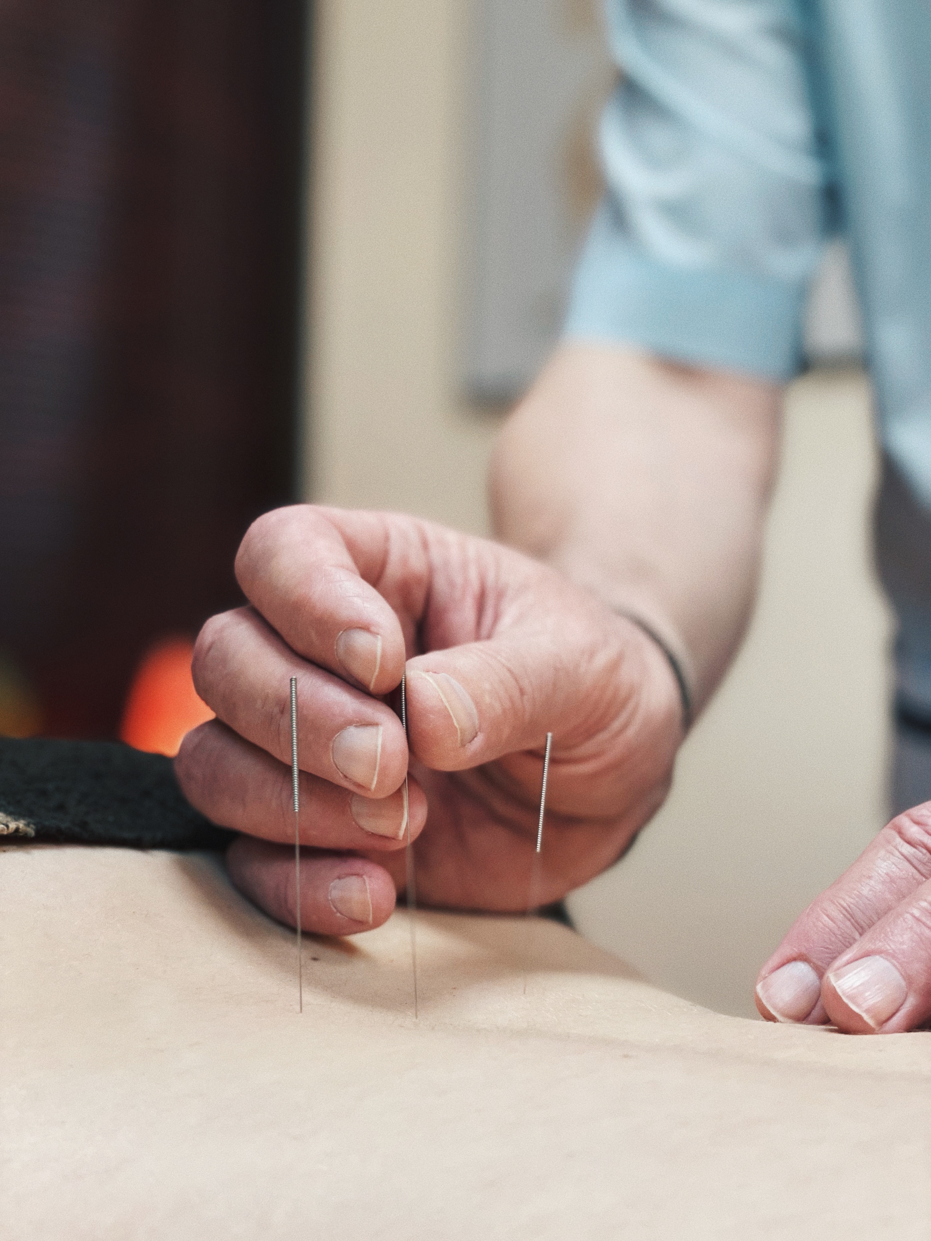 Иглоукалывание (акупунктура)