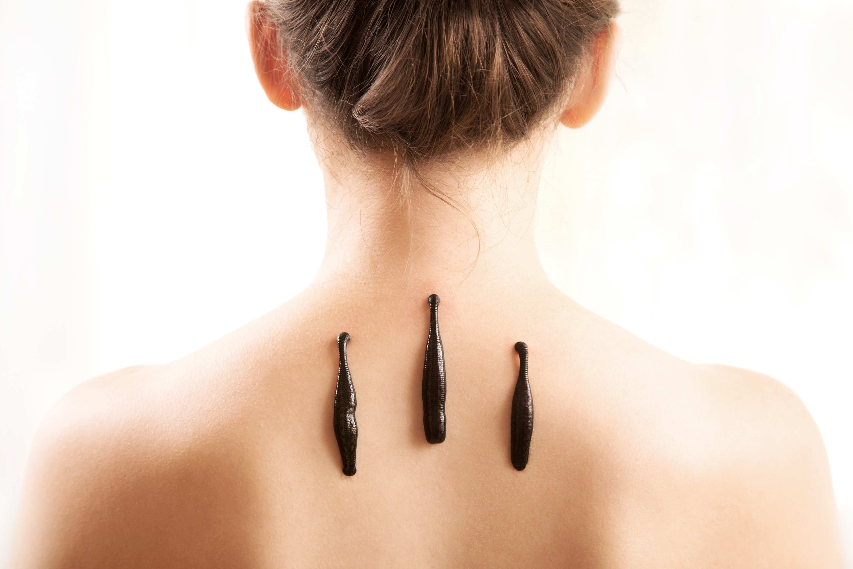 Гирудотерапия