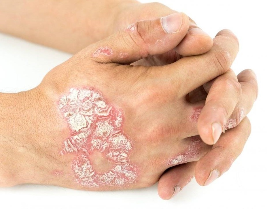 Псориаз. Взгляд традиционной медицины